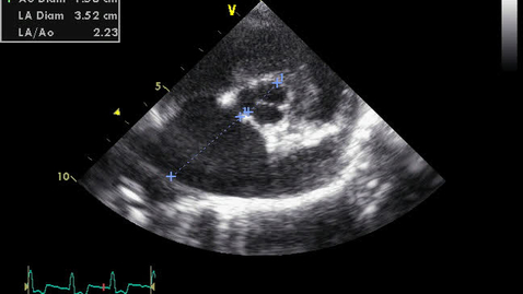 Thumbnail for Echocardiography : Clip 8