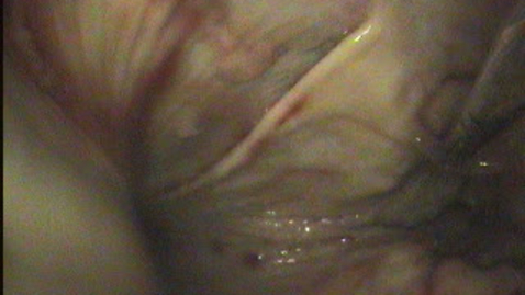 Thumbnail for URT endoscopy in the horse: Incorrect positioning of the catheter in to the dorsal pharyngeal recess: Clip 1