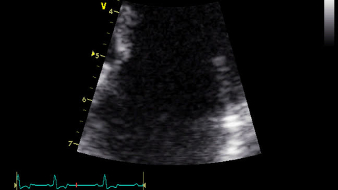 Thumbnail for entry Echocardiography: Clip 4