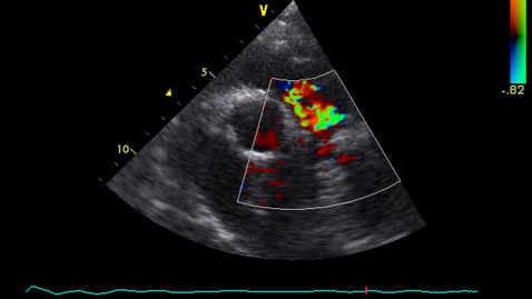 Thumbnail for entry Echocardiography: Clip 25