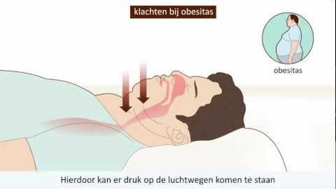 Thumbnail for S19 - Obstructief Slaap Apneu Syndroom (OSAS) - Wat is OSAS en  hoe kun je het voorkomen?