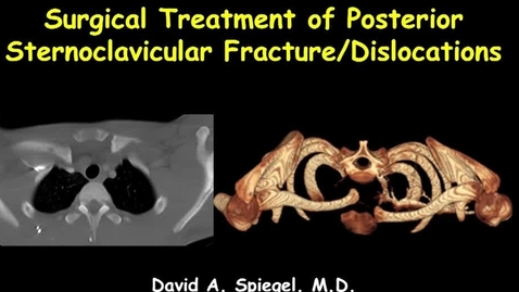 Thumbnail for Surgical Treatment of Posterior Sternoclavicular Fracture/Dislocations