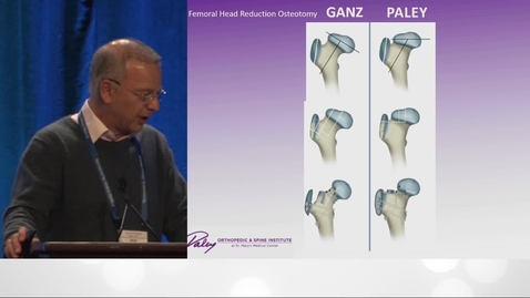 Thumbnail for Femoral Head Reduction in Perthes