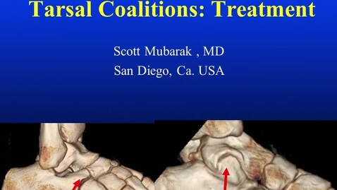 Thumbnail for Tarsal Coalitions: Treatment