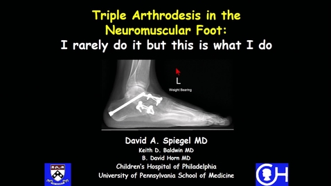 Thumbnail for Triple Arthrodesis in the Neuromuscular Foot