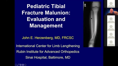 Thumbnail for entry Pediatric Tibia Fracture Malunion: Evaluation and Management