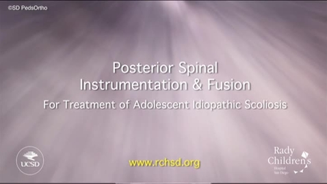 Thumbnail for entry Posterior Spinal Instrumentation and Fusion for Treatment of Adolescent Idiopathic Scoliosis