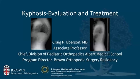 Thumbnail for Kyphosis: Evaluation and Treatment