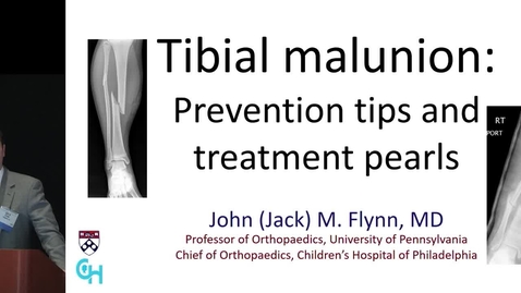 Thumbnail for Tibial Malunion: Prevention Tips and Treatment Pearls