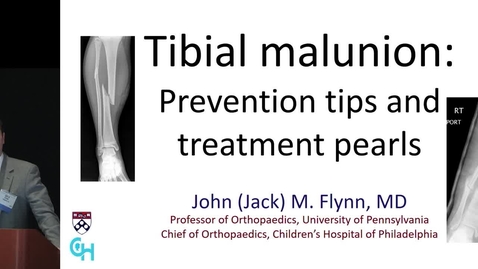 Thumbnail for entry Tibial Malunion: Prevention Tips and Treatment Pearls