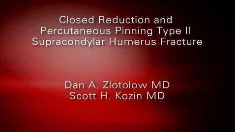 Thumbnail for Closed Reduction and Percutaneous Pinning Type II Supracondylar Humerus Fracture