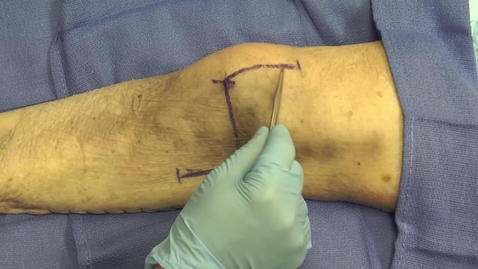 Thumbnail for Open Approach to Supracondylar Humerus Fractures