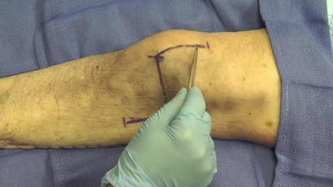 Thumbnail for entry Open Approach to Supracondylar Humerus Fractures