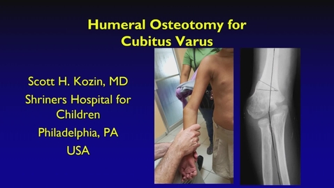 Thumbnail for entry IPOS® 2022: Humeral Osteotomy for Cubitus Varus