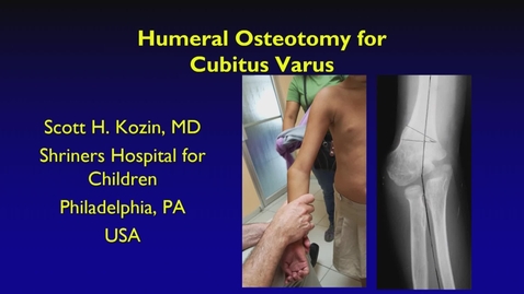Thumbnail for IPOS® 2022: Humeral Osteotomy for Cubitus Varus