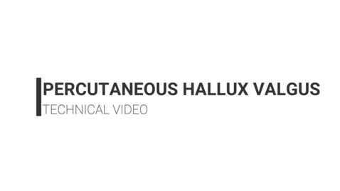 Thumbnail for entry Percutaneous Hallux Valgus Correction