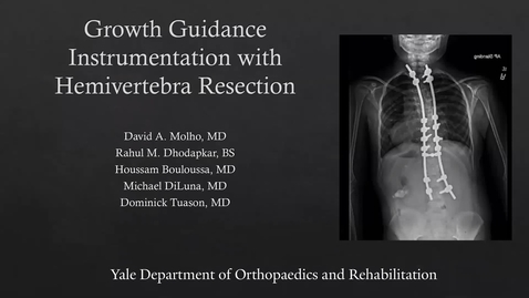 Thumbnail for Growth Guidance Instrumentation with Hemivertebra Resection