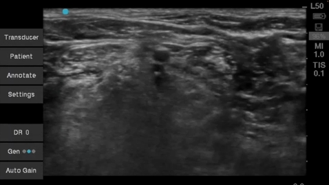 Thumbnail for entry Ultrasound Guided Interscalene Block