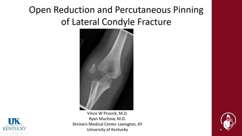 Thumbnail for entry Open Reduction and Percutaneous Pinning of Lateral Condyle Fracture