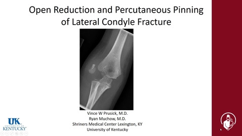 Thumbnail for Open Reduction and Percutaneous Pinning of Lateral Condyle Fracture