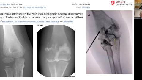 Thumbnail for 6. Humerus Lateral Condyle Fractures: US/MRI/Arthrogram - Is It Different Over the Border?