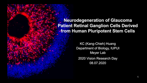 Thumbnail for entry Neurodegeneration of glaucoma patient retinal ganglion cells derived from human pluripotent stem cells