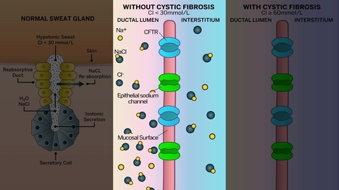 Thumbnail for CFTR Dysfunction in the Sweat Glands