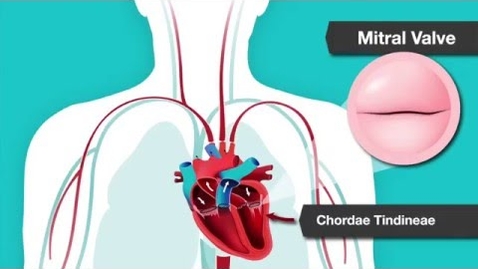 Thumbnail for entry Understanding Heart Murmurs, Aortic and Mitral Valve Problems