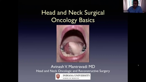 Thumbnail for entry Head/Neck Cancer Talk with Dr. Mantravadi