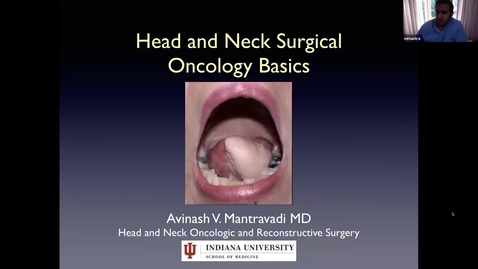 Thumbnail for Head/Neck Cancer Talk with Dr. Mantravadi