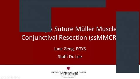 Thumbnail for entry Single suture Müller Muscle Conjunctival Resection (ssMMCR)