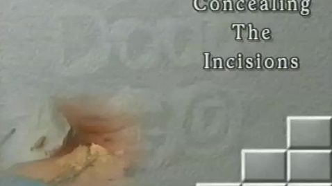 Thumbnail for yinjectconcealincision
