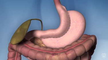 Video Biliopancreatic Diversion With Duodenal Switch