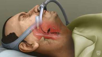 Video How CPAP controls sleep apnea Mayo Clinic