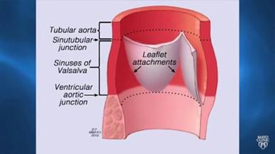 Marfan Syndrome Diagnosis And Treatment Mayo Clinic