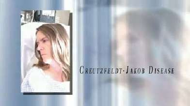 Cjd Creutzfeldt Jakob Disease Mayo Clinic