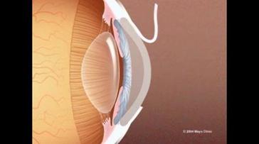 LASIK eye surgery Mayo Clinic