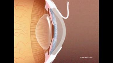 Intraocular Lens Orlando