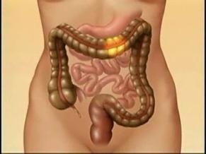 Irritable Bowel Syndrome - Symptoms And Causes - Mayo Clinic