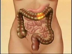 Video How Irritable Bowel Syndrome Affects You Mayo Clinic