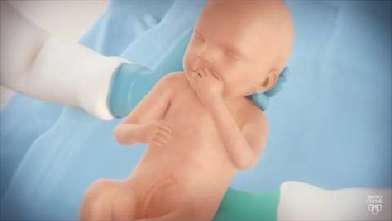 فيديو العملية القيصرية Mayo Clinic مايو كلينك