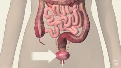 جراحة إزالة المثانة استئصال المثانة Mayo Clinic مايو كلينك