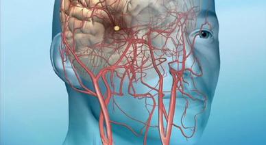 Carotid Artery Disease Doctors And Departments Mayo Clinic