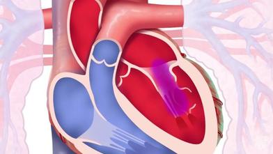 Video Mitral Valve Regurgitation Mayo Clinic La estenosis mitral o estenosis de la valvula mitral es una valvulopatia (cardiopatia valvular) caracterizada por el estrechamiento anormal del orificio de la valvula mitral del corazon. video mitral valve regurgitation