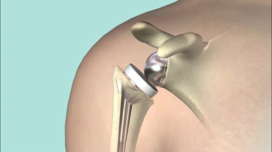 Video: Reverse shoulder replacement - Mayo Clinic