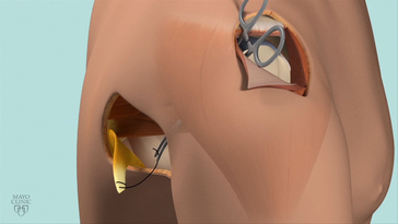 Rotary cuff injury hot sale treatment