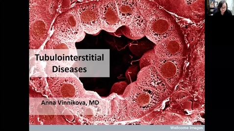 Thumbnail for entry 201005-M2-9am-RENL-Interstitial Kidney Disease-Vinnikova