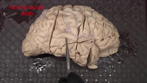 Thumbnail for Sulcal widening with narrative