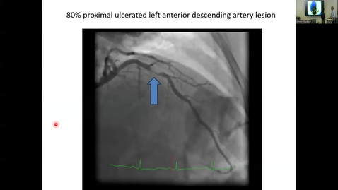 Thumbnail for 240814 - 10AM - M2 - CARD - Acute Coronary Syndromes (ACS)