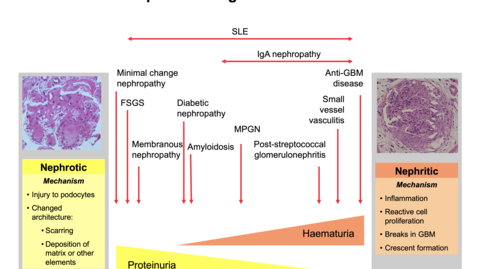 Thumbnail for entry The Spectrum of Glomerulonephritis
